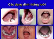 Điều trị dính thắng lưỡi ở trẻ càng sớm càng tốt