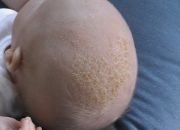 Điều trị cứt trâu trên da đầu trẻ sơ sinh