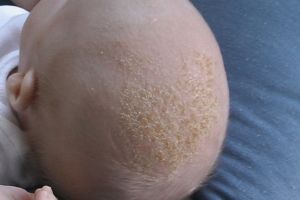 Điều trị cứt trâu trên da đầu trẻ sơ sinh