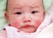 Bệnh chàm ở trẻ và cách điều trị dứt điểm