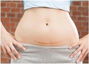 Phụ nữ sau sinh mổ nên ăn gì để nhanh lành sẹo, sữa nhanh về