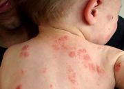 Bé bị nổi mẩn đỏ khắp người và ngứa thì nên làm gì?