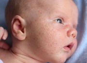Mụn sữa ở trẻ sơ sinh và cách điều trị mà các mẹ nên biết