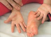 Bệnh tay chân miệng ở trẻ em: Những điều bố mẹ cần biết