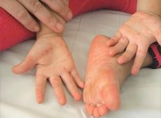 Bệnh tay chân miệng ở trẻ em: Những điều bố mẹ cần biết