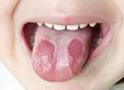 Dấu hiệu nhận biết viêm lưỡi bản đồ ở trẻ em