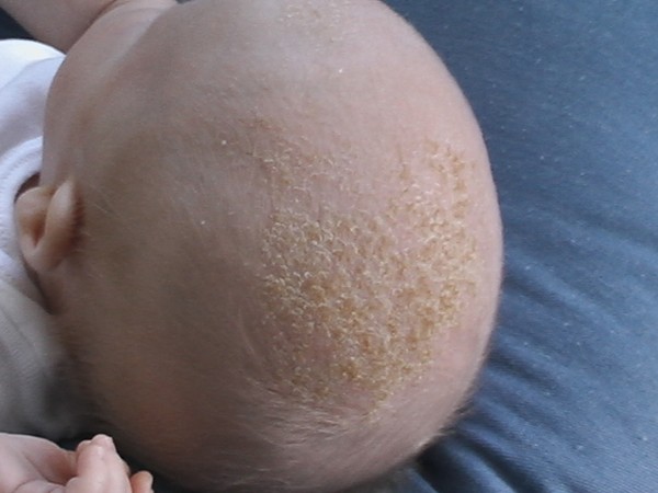 Trị phân trâu trên da đầu trẻ sơ sinh