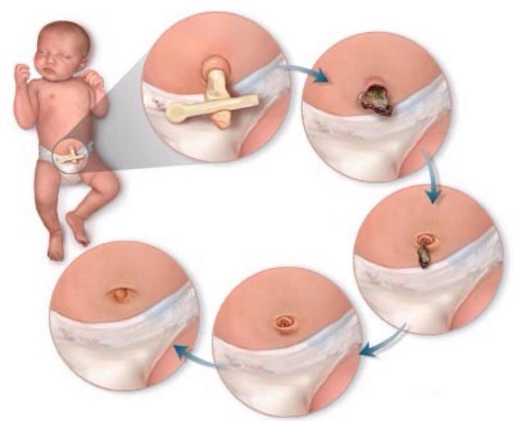 Trẻ sơ sinh sau bao lâu thì rụng dây rốn và cách chăm sóc như thế nào?