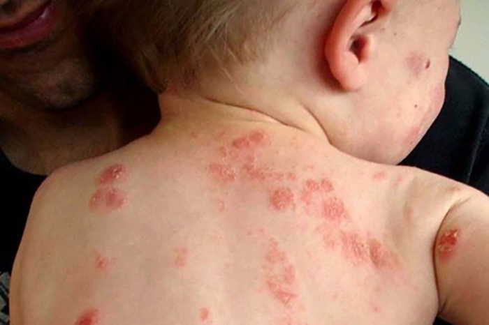 Chàm Eczema khiến da bé bị lở loét