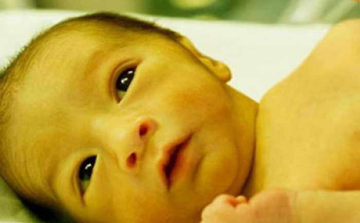 trẻ sơ sinh bị vàng da là gì