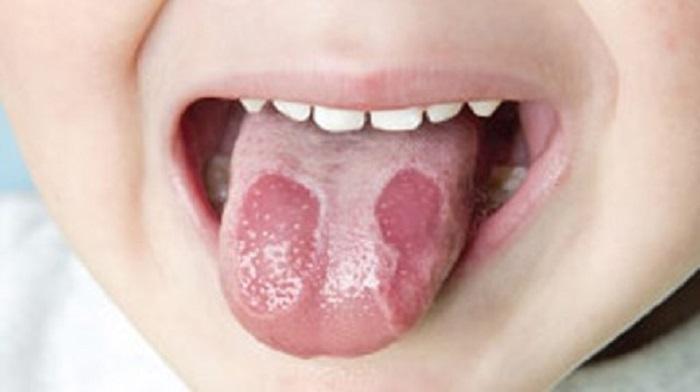 Dấu hiệu nhận biết bệnh viêm lưỡi bản đồ ở trẻ em